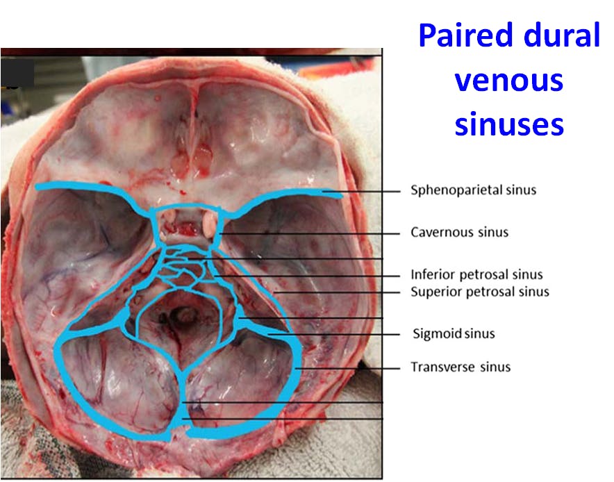 Cranial meninges & dural venous sinuses